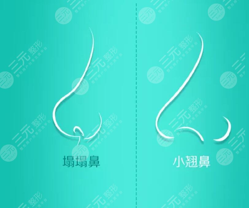 鼻子整形后要注意什么？