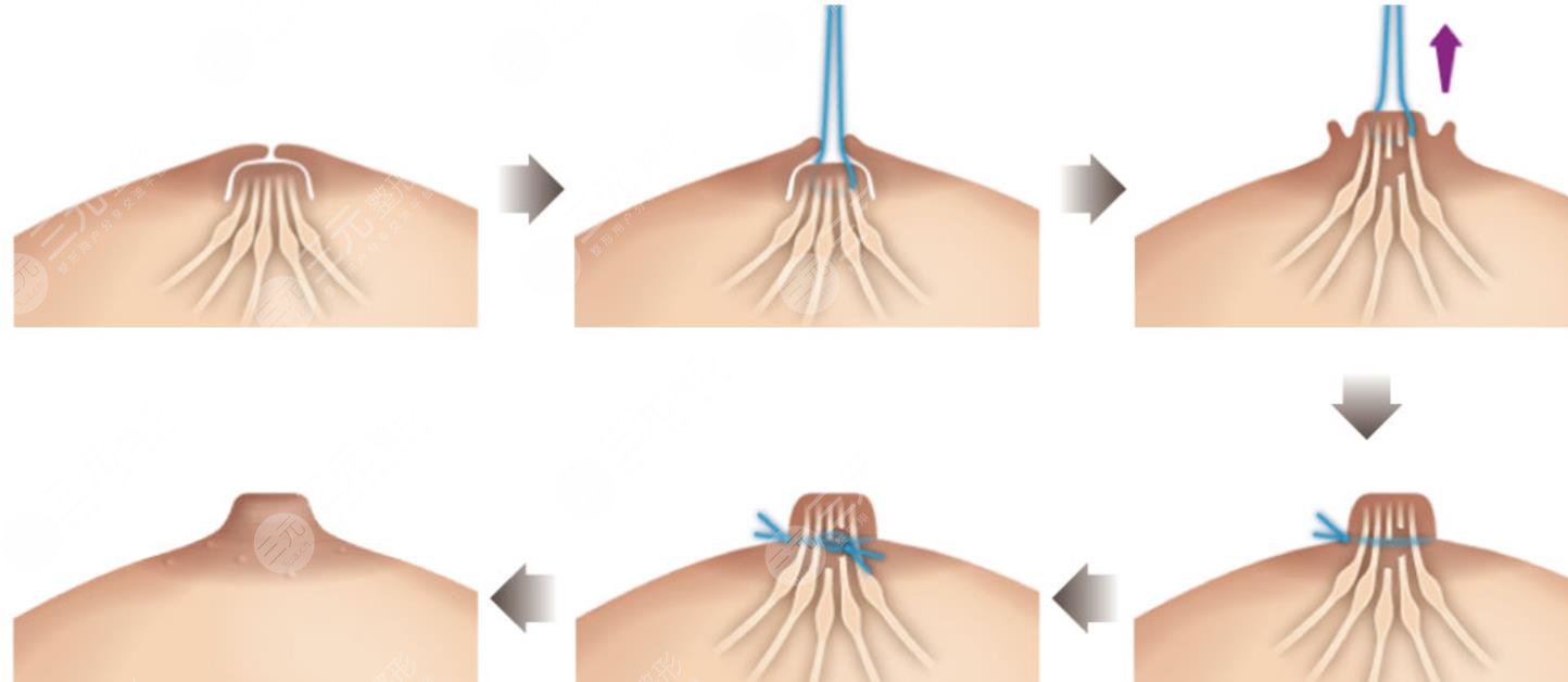 乳头凹陷矫正:该院苏开展的乳头凹陷矫正是比较常规的乳房整形手术,该