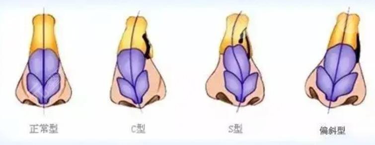 歪鼻矫正