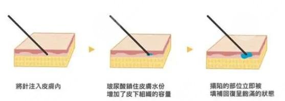 玻尿酸