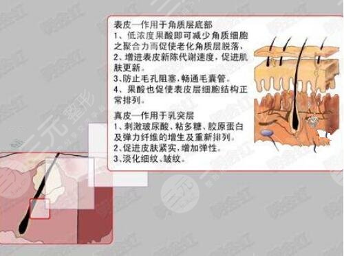 痘坑修?复果酸换肤有用吗?