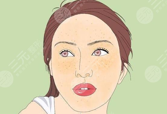 激光缓解黄褐斑多少钱一个疗程?