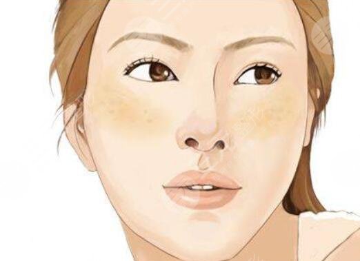 激光缓解黄褐斑多少钱一个疗程？技术原理剖析，术后护理注意事项告知！