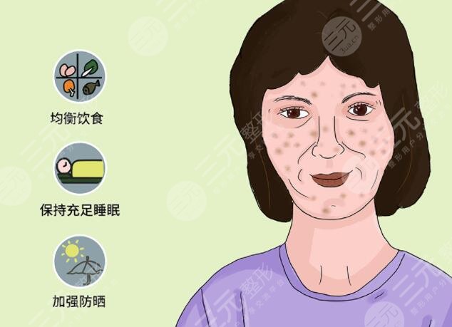 激光缓解黄褐斑原理是什么?