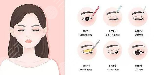 欧式割双眼皮多?少钱?