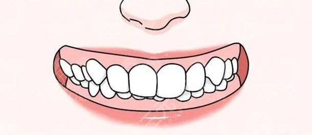 深覆合一定要做矫正吗？深覆合矫正前后脸型对比图|合适的年纪是多久？