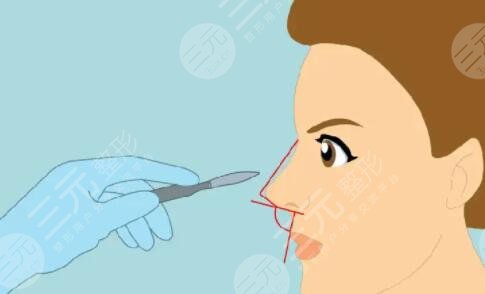 蒜头鼻怎么变小？