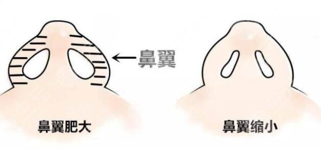 蒜头鼻缩小整形手术可以维持多长时间?