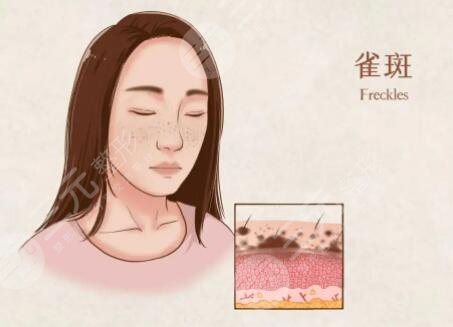 快速美白祛斑的方法是什么?