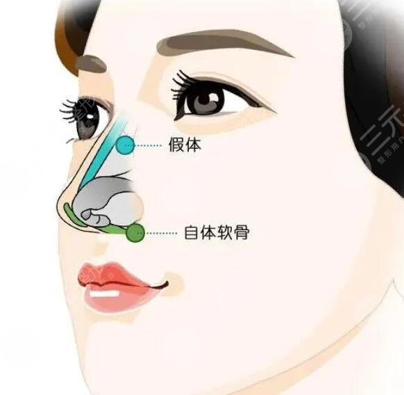膨体材料隆鼻多少钱2023新版，手术材料的优缺点解析、术后护理小贴士~