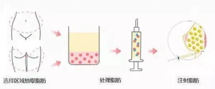 脂肪隆胸