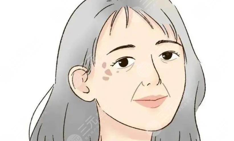 脸上长老年斑的原因是什么?