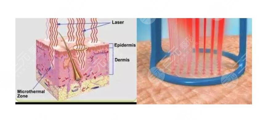 激光缓解痤疮效果?怎么样
