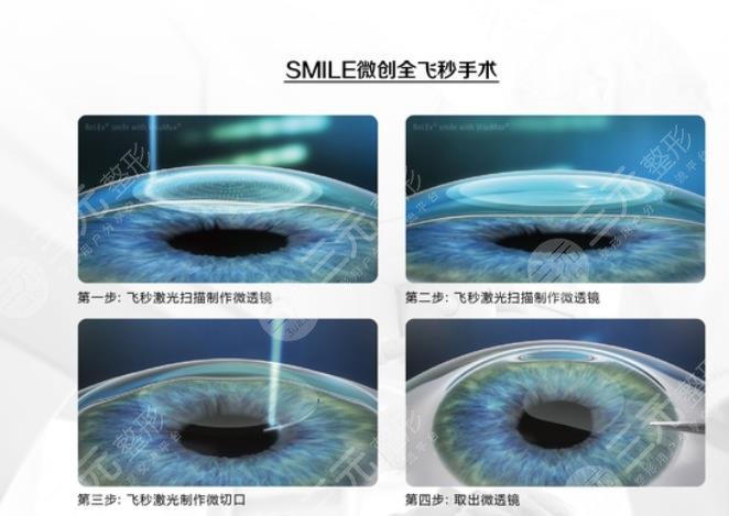 眼睛近视如何?缓解好?