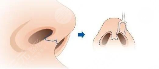 鼻头缩小手术是什么?