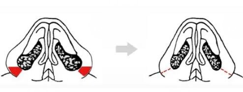 鼻头缩小手术需要多少钱?