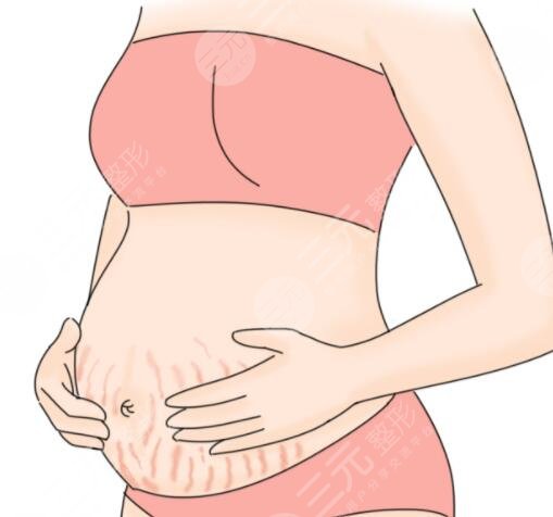 防止妊娠纹的方法有哪些有效？妊娠纹产生的原因是什么？