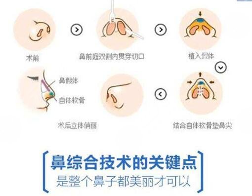 假体隆鼻手术过程要很久吗?