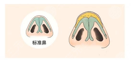 缩鼻翼和鼻头多少钱?