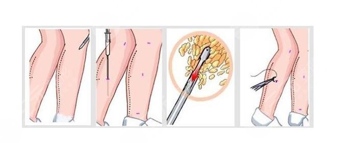 预防小腿变粗的注意事项