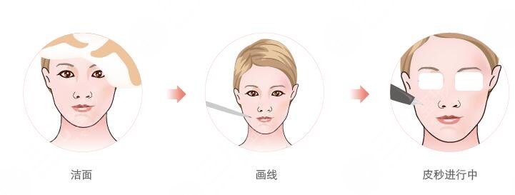 镭射激光嫩肤术后注意事项