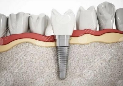 陆军总医院种植牙多少钱
