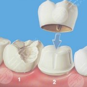 门牙有缝怎么缓解比较合理？烤瓷牙矫正、戴牙套等优势分析！