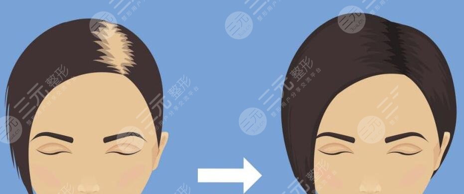 植发3000个毛囊价格是多少?