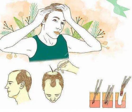 头发种植能保持多久时间?