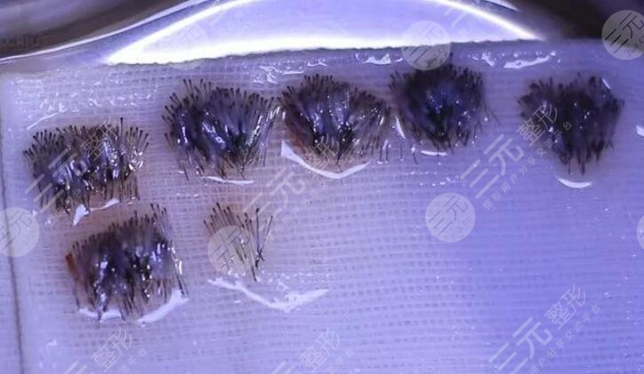 做完头发种植手术后需要注意什么?