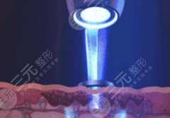 c6激光祛斑价格多少钱？原理分析_技术优势_注意事项