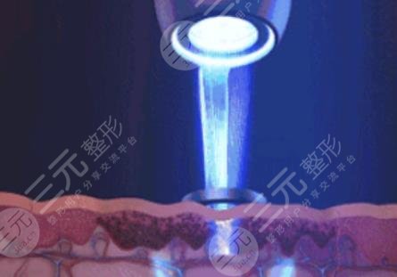 激光祛斑