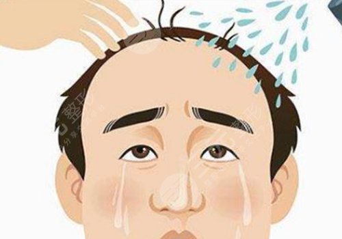 纹发和植发哪个效果好?