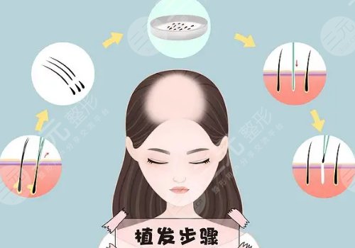 纹发和植发哪个效果好?