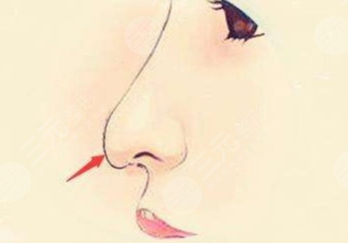 宝尼达隆鼻可以维持多久?