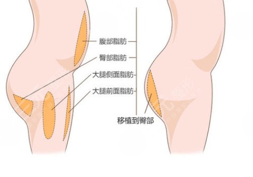 脂肪填充臀部可以维持多久？