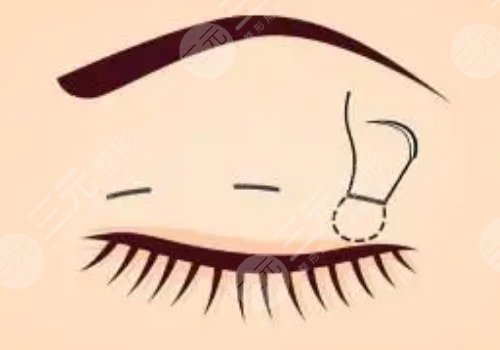 成都米兰柏羽割双眼皮医生介绍