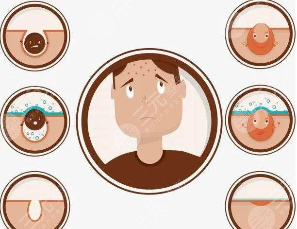 如何快速去除痤疮见效快?