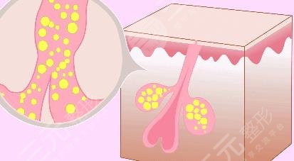 像素激光去痘疤有?效果吗?