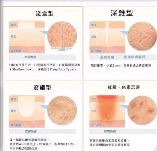 激光去痤疮注意事项有哪些?