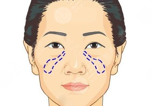 苹果肌断层是什么原因？