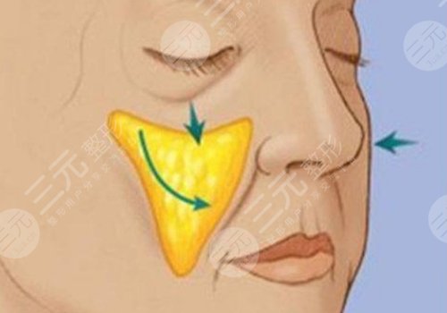 苹果肌断层是什么原因？