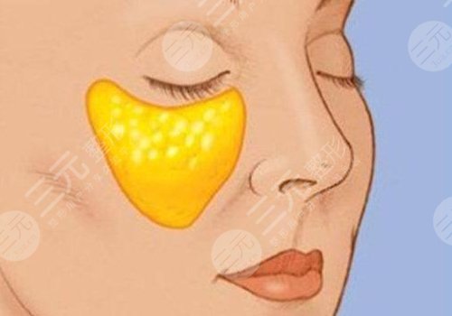 苹果肌断层是什么原因？