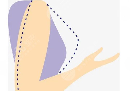 奥美定取出手术后要注意些什么？