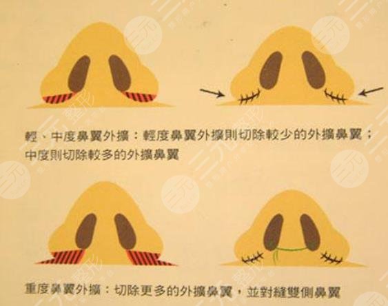 鼻翼缩小