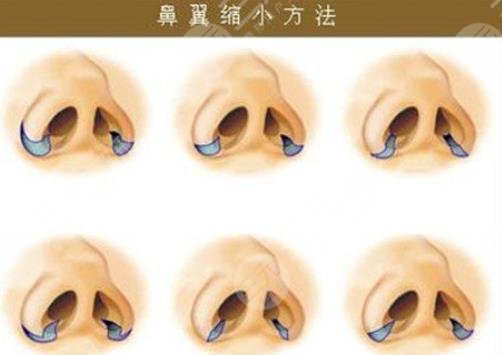 鼻翼缩小