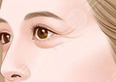 怎么消除眼角的皱纹？6种日常改良细纹的方式以及热门医美介绍！