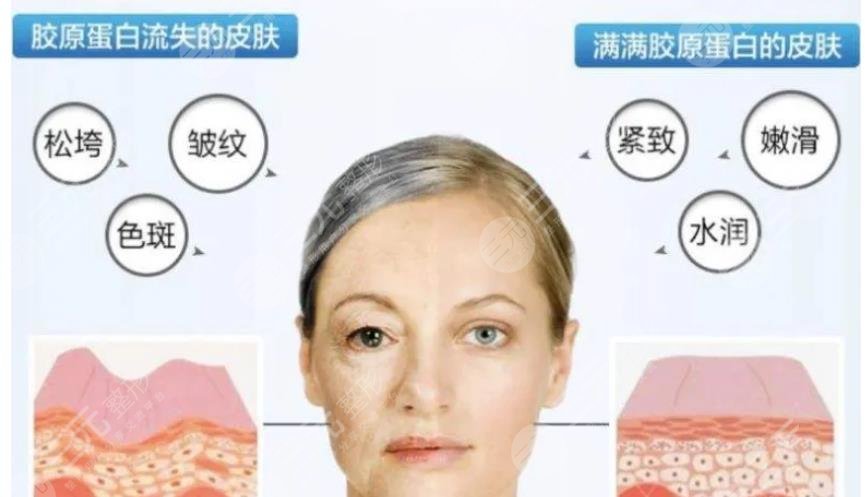 怎么消除眼角的皱纹?