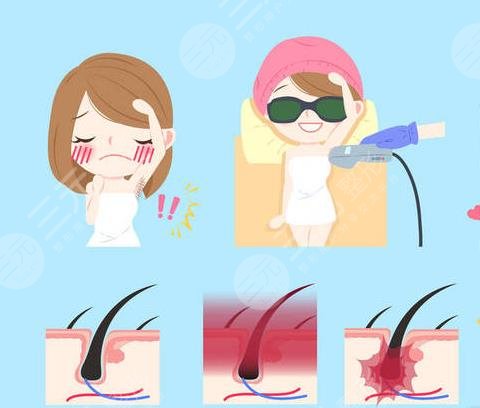 冰点脱毛的具体价?格曝光