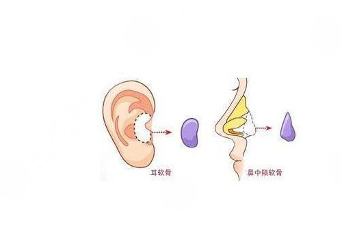 重庆华美做鼻子怎么样?